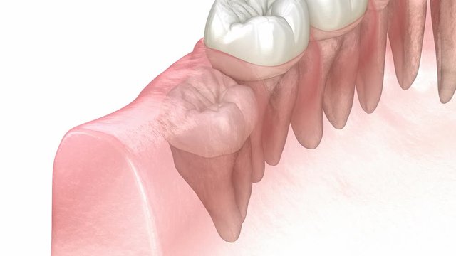 Vertical, Horizontal and Distal impaction of Wisdom tooth. Medically accurate tooth 3D animation 