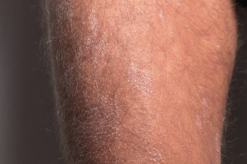 Fototapeta premium Large plaque parapsoriasis on caucasian man legs