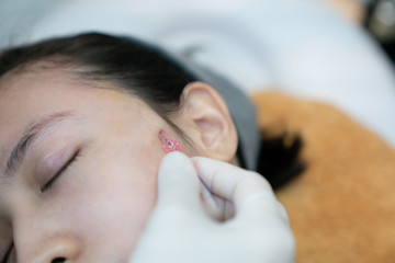 Close-up of fine Thread Lifting, PDO thread. Aesthetic beauty anti aging, face lifting surgery.