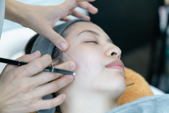 Close-up doctor drawing contour line before fine Thread Lifting, PDO thread. Aesthetic beauty anti aging, face lifting surgery.