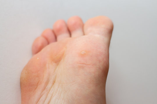wart on the foot 
