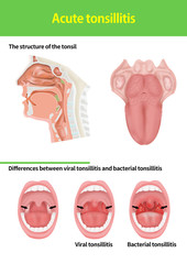 acute tonsillitis medical illust