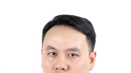Close up of serious Asian bald man alopecia isolated on white background. Human hair loss solution concept.