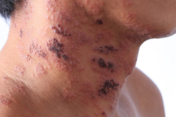Herpes zoster or Shingles or Zoster infected by Varicella Zoster Virus or VZV. characterized by a...