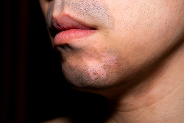 Fototapeta premium Close up front view of Asian man with Vitiligo. Abnormal skin Melanocyte Pigment.