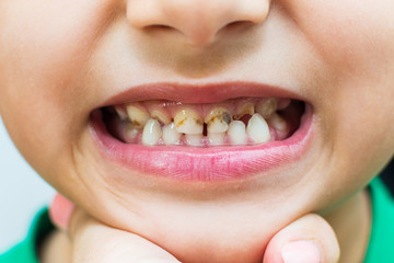Fototapeta premium caries in the child. teeth with caries close-up. primary teeth.