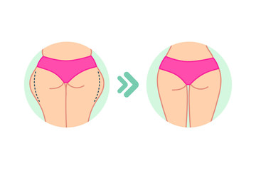 Female fat hips. Woman bottoms. Flat design. Before and after diet, fitness or liposuction. Woman buttocks vector illustration. Cellulite treatment program, weight loss.