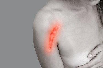 Close up of female shoulder with a scar after install a metal plate bone fracture surgically.