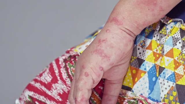 Shingles, Zoster or Herpes Zoster symptoms on arm