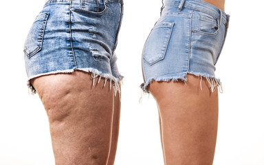 Comparison of legs with and without cellulite - obrazy, fototapety, plakaty