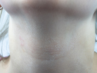 atopic dermatitis, severe dry skin in the front of the neck in a girl of 12 years old