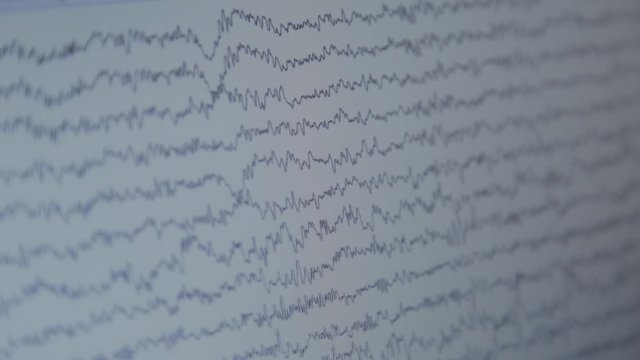 Close-up shot of monitor with results of monitoring the human brain activity.