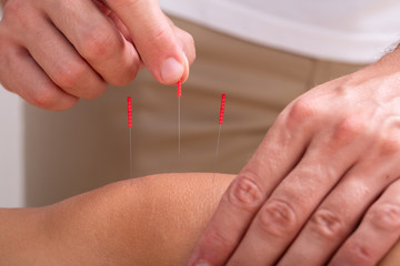 Acupuncturist Inserts Needles Into Person's Knee