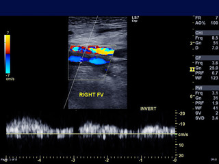 A Doppler ultrasound is a noninvasive test that can be used to estimate the blood flow through your...