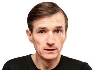 Fototapeta premium Comparison of sick eye and healthy. Man with sick eye for conjunctivitis on a white background. The man has a sad face with wrinkles on his forehead. Isolated