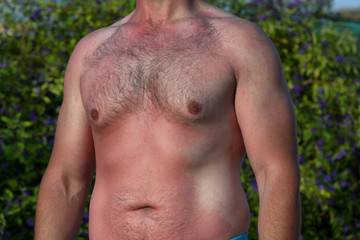 Naklejka premium Sunburned painful woman from the sun. Painful sunburn red skin on holiday.