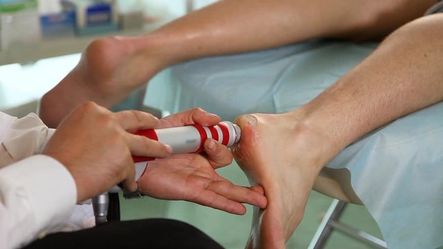 Heel treatment procedure with Shock Wave Therapy.Close up