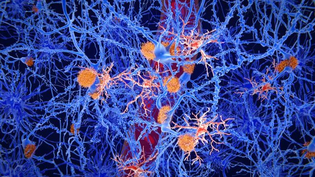 Animation of microglia cells (pink) in the brain of a person with Alzheimer's disease