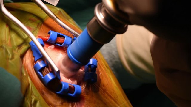 Neurosurgeon performing brain surgery and drilling human skull