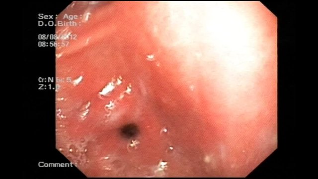  Polyp pylorus - a game of hide and seek.