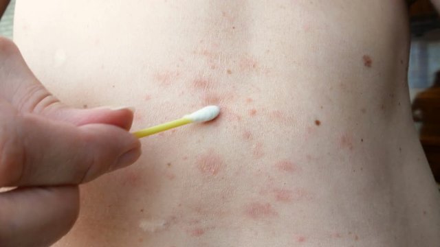 skin rash treatment on woman body. Shingles, Disease, Herpes zoster, varicella-z, lichenoid dermatitis