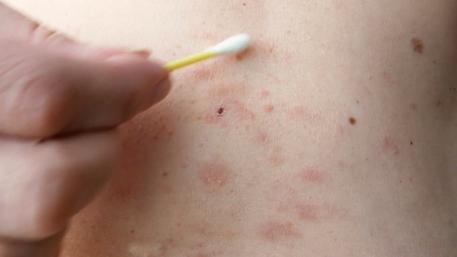 skin rash treatment on woman body. Shingles, Disease, Herpes zoster, varicella-z, lichenoid dermatitis