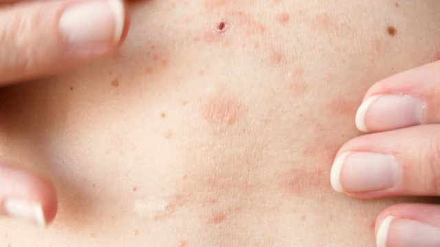 skin rash treatment on woman body. Shingles, Disease, Herpes zoster, varicella-z, lichenoid dermatitis