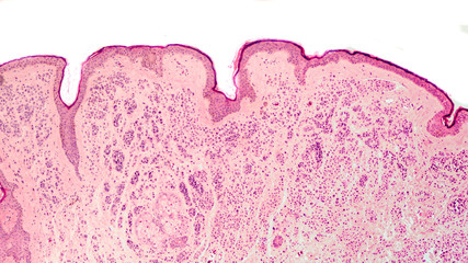 Photomicrograph of a skin biopsy showing an intradermal nevus, a tumor of benign melanocytes, often...