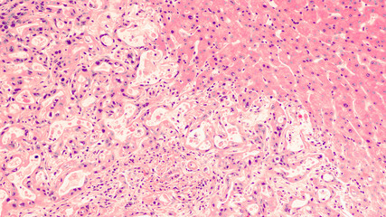 Microscopic image of cancer of the pancreas (pancreatic adenocarcinoma), left, metastatic to liver (upper right). - obrazy, fototapety, plakaty