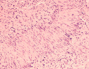 Photomicrograph of a schwannoma, a benign soft tissue tumor of peripheral nerve sheath, with...
