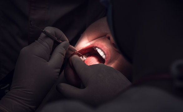 tdentistry. dental treatment, close-up. teeth and caries.