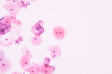 View in microscopic of abnormal human cervix cells.Koilocyte cell criteria of Human Papilloma Virus...