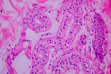 Section tissue of breast cancer view in microscopy.Ductal cell carcinoma.