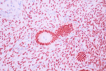 Section tissue of breast cancer view in microscopy.Ductal cell carcinoma.