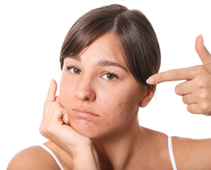 Young woman with acne problem on white background