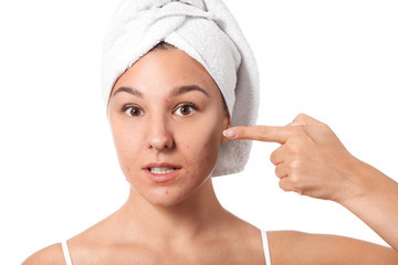 Young woman with acne problem on white background