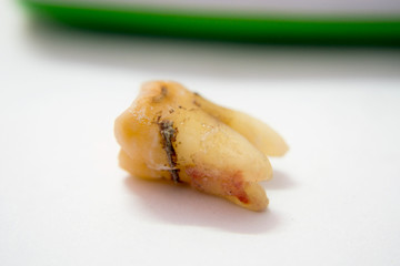 Tooth decay due to toothache and limestone