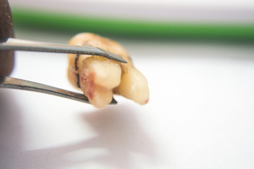 Tooth decay due to toothache and limestone