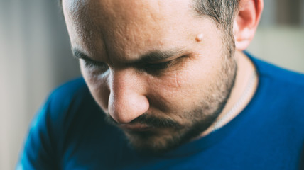 Fototapeta premium The tumor on the face of men near his temple , Lipoma Wen or zit, ugly acne, dermatology and ugliness