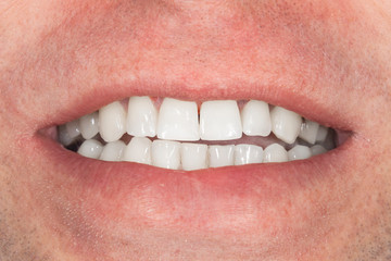 Obraz premium teeth whitening close-up macro. Hygiene of the human oral cavity after admission to the dentist