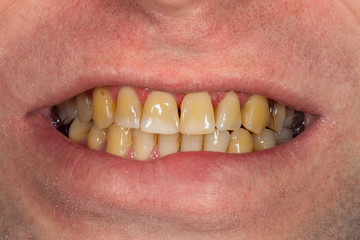 smoking, plaque on teeth