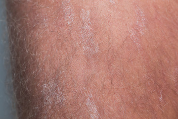 Large plaque parapsoriasis on caucasian man legs