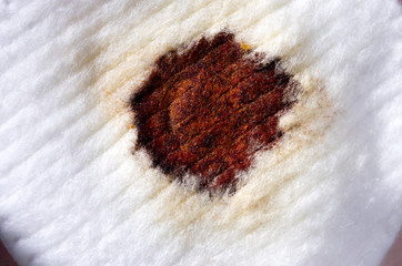 A wound on the body. A sterile cotton pad with an antiseptic iodine solution is applied to a fresh...
