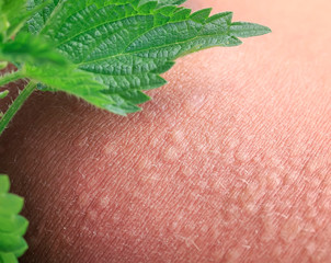 plant stinging nettle lying on irritated human skin covered with small wrinkles ,cracks and causes a burn with blisters