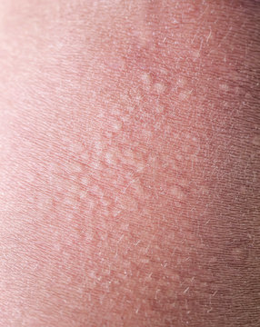 background texture of pink irritated human skin covered with small wrinkles ,cracks and blistering
