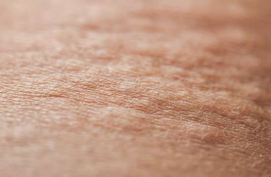 side view of the texture of human pink, irritated skin covered with wrinkles, hairs and blisters from burns and allergies