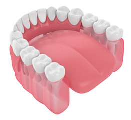3d render of implant partial denture