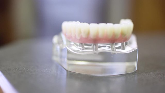 Panning model of teeth being held in place by dental implants