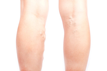 varicose veins on the legs of a girl, phlebeurysm disease