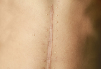 Fototapeta premium old scar wound from operation in medical 